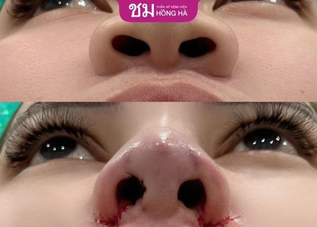 Cắt cánh mũi có bị sưng không