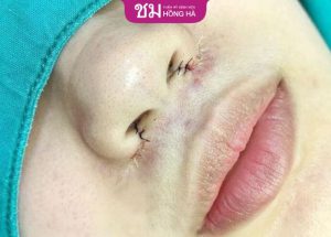 Cắt cánh mũi nội soi giá bao nhiêu? – Giá tốt tại Hồng Hà