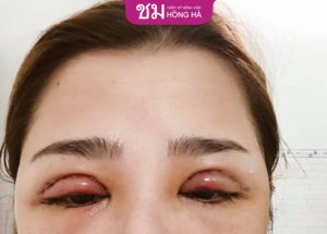 Cắt mí 1 tháng vẫn sưng: Nguyên nhân, cách khắc phục