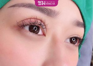 Cắt mí 20 ngày vẫn sưng? – Bí quyết ngăn ngừa mắt sưng