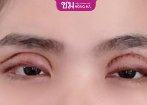Cắt mí 3 tháng vẫn sưng – Dấu hiệu bất thường, chớ xem nhẹ