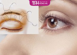 Cắt mí bao lâu thì cắt chỉ – Chăm sóc đúng cách sau cắt mí