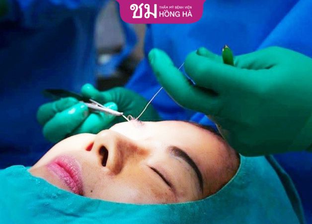 Cắt chỉ sau cắt mí không gây đau đớn