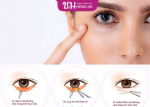 Cắt mí dưới bao lâu thì lành – 4 Yếu tố tác động thời gian lành