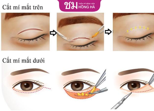 Thời gian lành thương sau cắt mí dưới bao lâu phụ thuộc vào công nghệ thực hiện