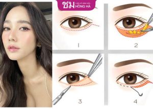 Cắt mí dưới bao nhiêu tiền? 4 Yếu tố ảnh hưởng đến giá