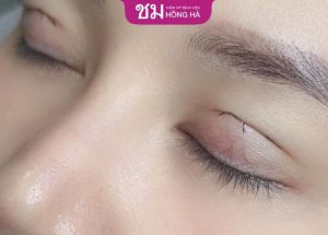 Cắt mí sau 5 ngày sưng không – 5 Lưu ý giúp mắt đẹp quyến rũ