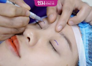 Cắt mí sưng bao lâu – Các lưu ý giúp mí nhanh hồi phục