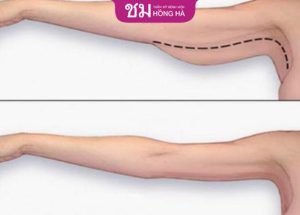 Chăm sóc sau hút mỡ bắp tay – Bí quyết nhanh lành, đẹp tự nhiên