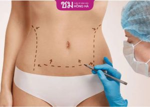 Chi phí phẫu thuật tạo hình thành bụng – Cập nhập mới nhất