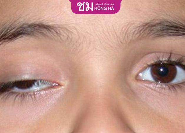 Một trong những biến chứng nguy hiểm khi bị sụp mí mắt bẩm sinh là lid lag và hở mi