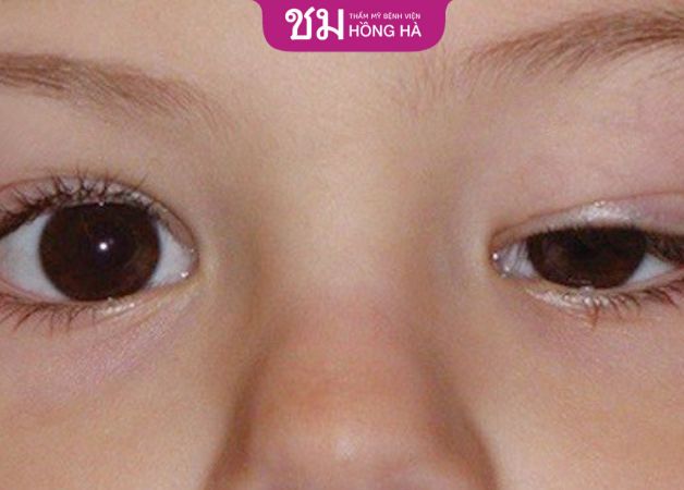 Nguyên nhân gây ra tình trạng sụp mí bẩm sinh là do chít hẹp mi
