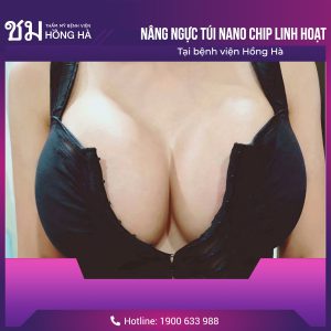 Có nên nâng ngực trả góp không – Cách nhận ưu đãi nâng ngực