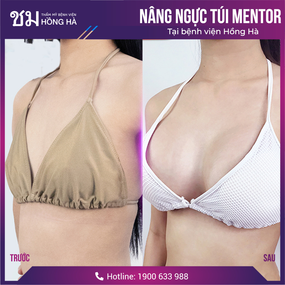 Lựa chọn dịch vụ thẩm mỹ theo com bo tại Thẩm mỹ bệnh viện Hồng Hà để tiết kiệm chi phí