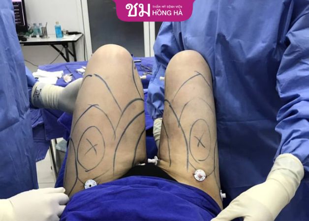 Hút mỡ đùi không nguy hiểm