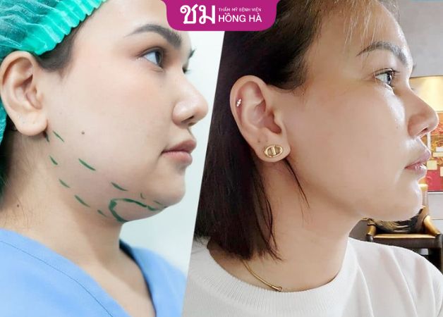 Khách hàng sở hữu cằm V line sau hút mỡ thừa vùng cằm