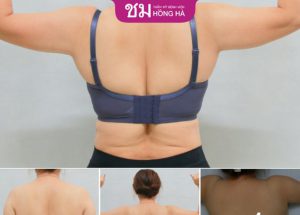 Hút mỡ vai có tốt không- Hướng dẫn chăm sóc đúng cách