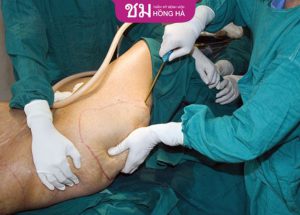 Kinh nghiệm hút mỡ đùi an toàn, không béo trở lại