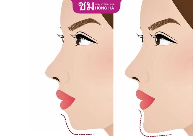 Trượt cằm là phương pháp thẩm mỹ không gây nguy hiểm