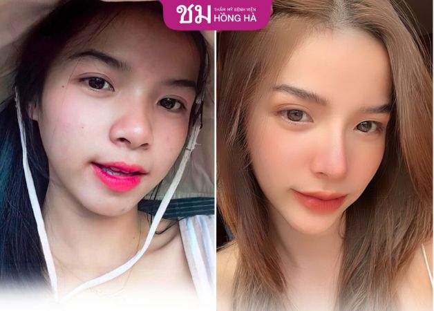 Mũi đẹp thon gọn sau khi nâng mũi bọc sụn