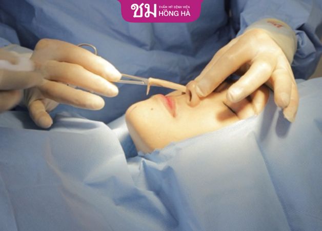 Nâng mũi bọc sụn sinh học