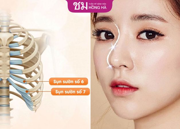 Nâng mũi bọc sụn có tốt không khi dùng sụn tự thân