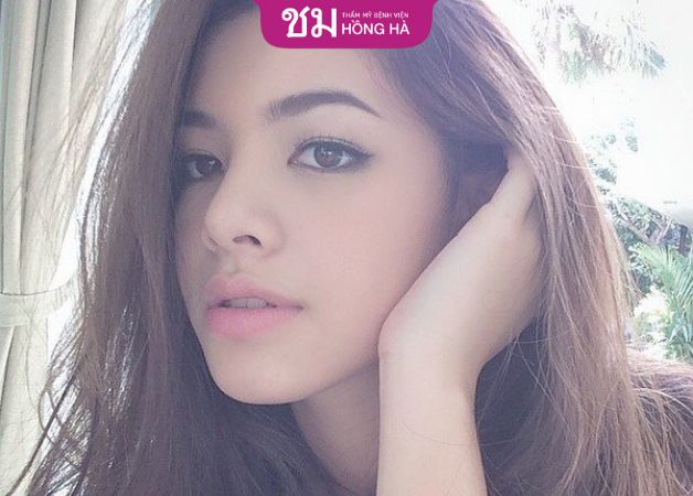 Dáng mũi mềm mại và đẹp tự nhiên sau nâng mũi bọc sụn