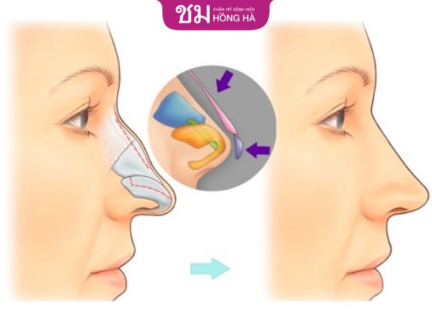 Nâng mũi bọc sụn duy trì hơn 10 năm