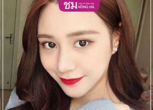 Nâng mũi cấu trúc bao lâu thì ổn định- Hướng dẫn chăm sóc