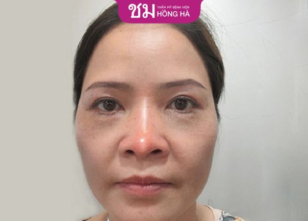 Để tình trạng trên kéo dài khiến form mũi biến dạng