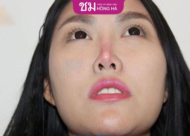 Gây ảnh hưởng đến tính thẩm mỹ của gương mặt