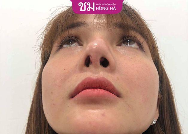 Khách hàng nâng mũi bị tụt sụn