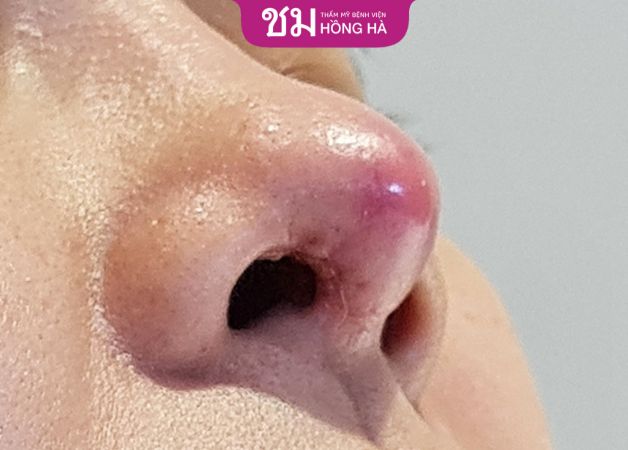 Khi thấy đầu mũi bóng đỏ sau nâng mũi cấu trúc rất có thể sụn nâng đã bị tụt