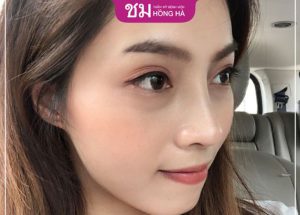 Nâng mũi cấu trúc có nguy hiểm không – 4 yếu tố ảnh hưởng