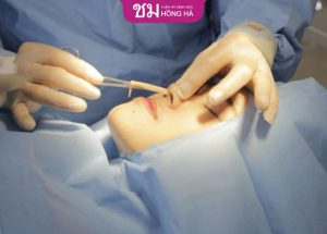 Nâng mũi sụn nhân tạo bao lâu thì lành? Bác sĩ hồng hà giải đáp