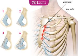 Nâng mũi sụn sườn giá bao nhiêu? – Thẩm mỹ Bệnh viện Hồng Hà