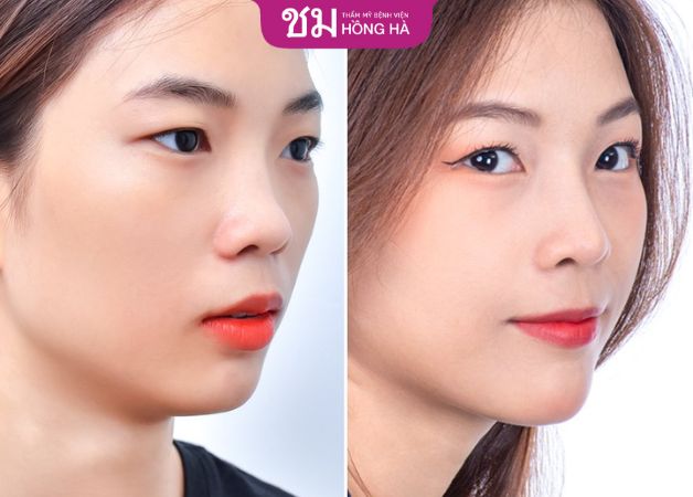 Phương pháp nâng mũi sụn sườn vĩnh viễn