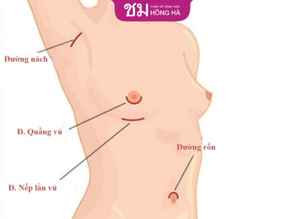Chọn đường mổ sau nâng ngực