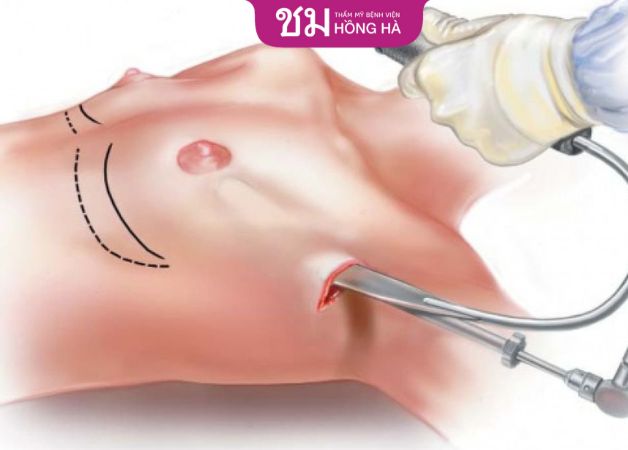 Nâng ngực qua đường nách là kỹ thuật phổ biến được áp dụng hiện nay