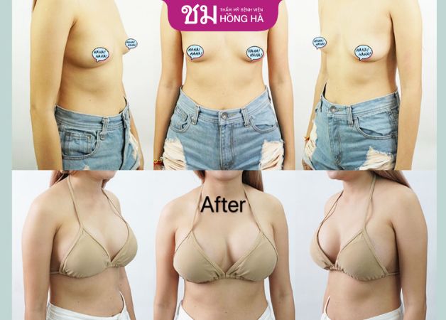 Khách hàng feedback hài lòng sau khi nâng ngực tại Hồng Hà