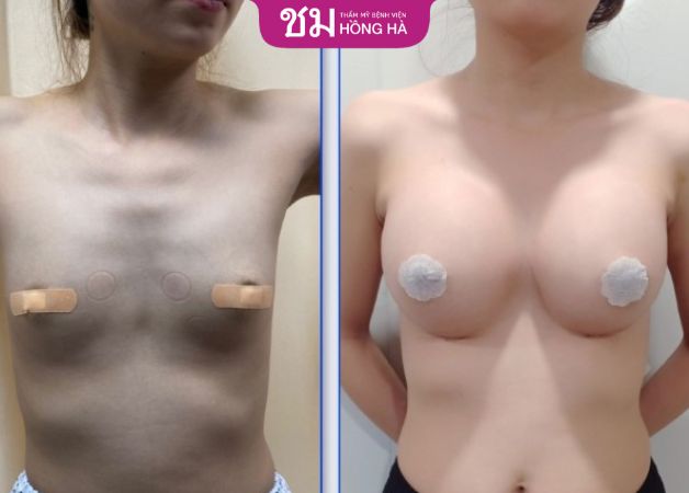 Giải cứu vòng 1 teo léo trở nên căng tròn quyến rũ