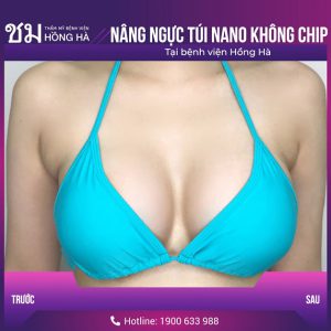Nâng ngực xong có sinh con được không – 3 lưu ý quan trọng