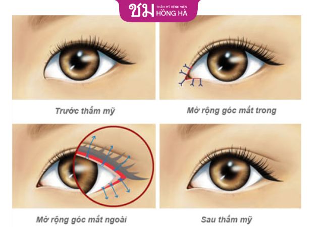 Kỹ thuật thẩm mỹ mắt ảnh hưởng đến giá dịch vụ