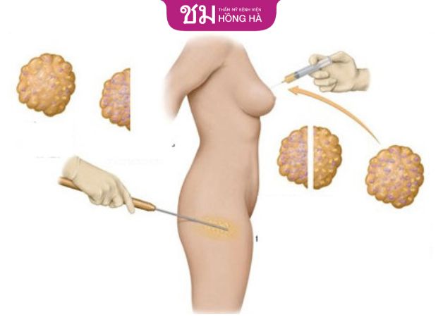 Nâng ngực bằng mỡ tự thân