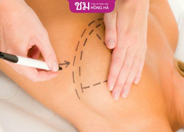 Thẩm mỹ nâng ngực là phương pháp an toàn