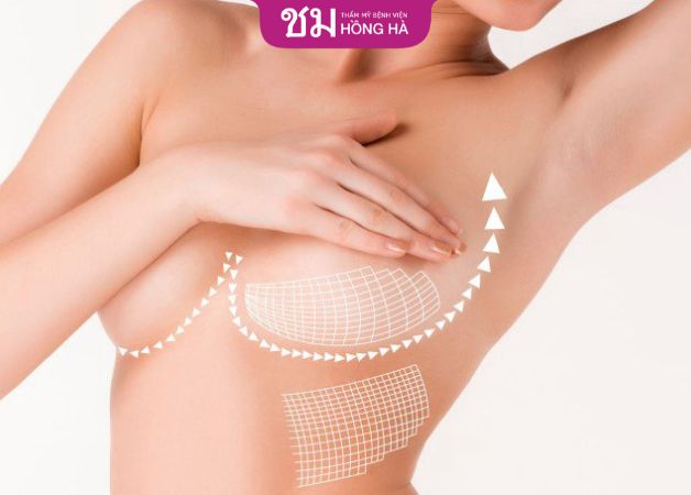 Nâng ngực có độ bền 10 - 20 năm