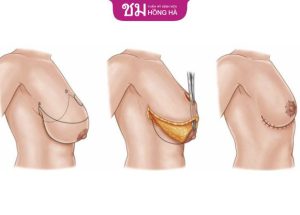 Thu gọn ngực xệ – Hồi sinh vòng 1 căng đầy, quyến rũ