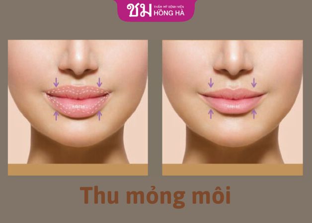 Thu mỏng môi có thể đem đến kết quả thẩm mỹ vĩnh viễn