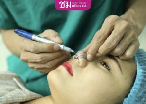 Thu nhỏ đầu mũi có đau không? – Cách giảm đau hiệu quả