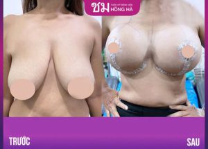 Treo ngực sa trễ có nguy hiểm không – 3 Lưu ý đảm bảo an toàn